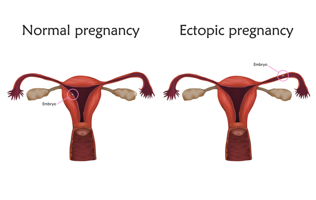 outcome of ectopic pregnancy